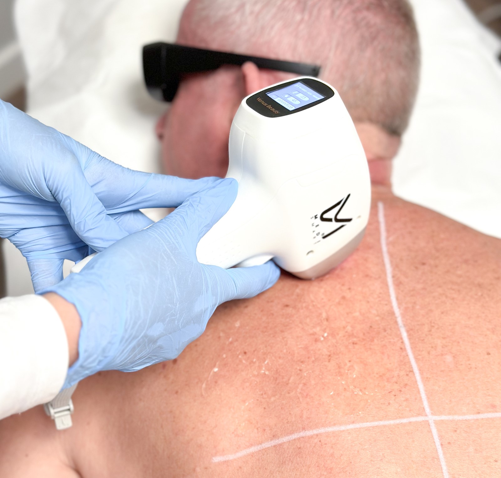 Revolutionaire Oplossing: Definitief Laser Ontharen voor Gladde Huid