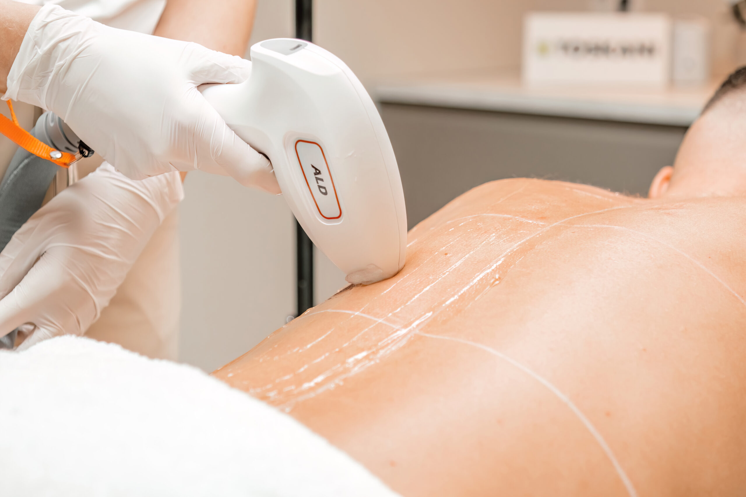 Ontdek de Voordelen van Laser Ontharen bij Onze Kliniek