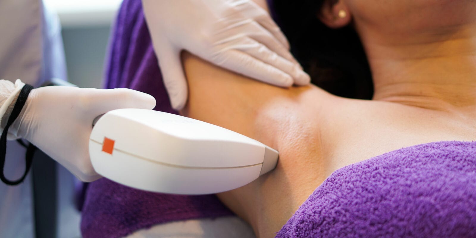 Revolutionaire Oplossing: Laser Ontharen voor Permanente Resultaten