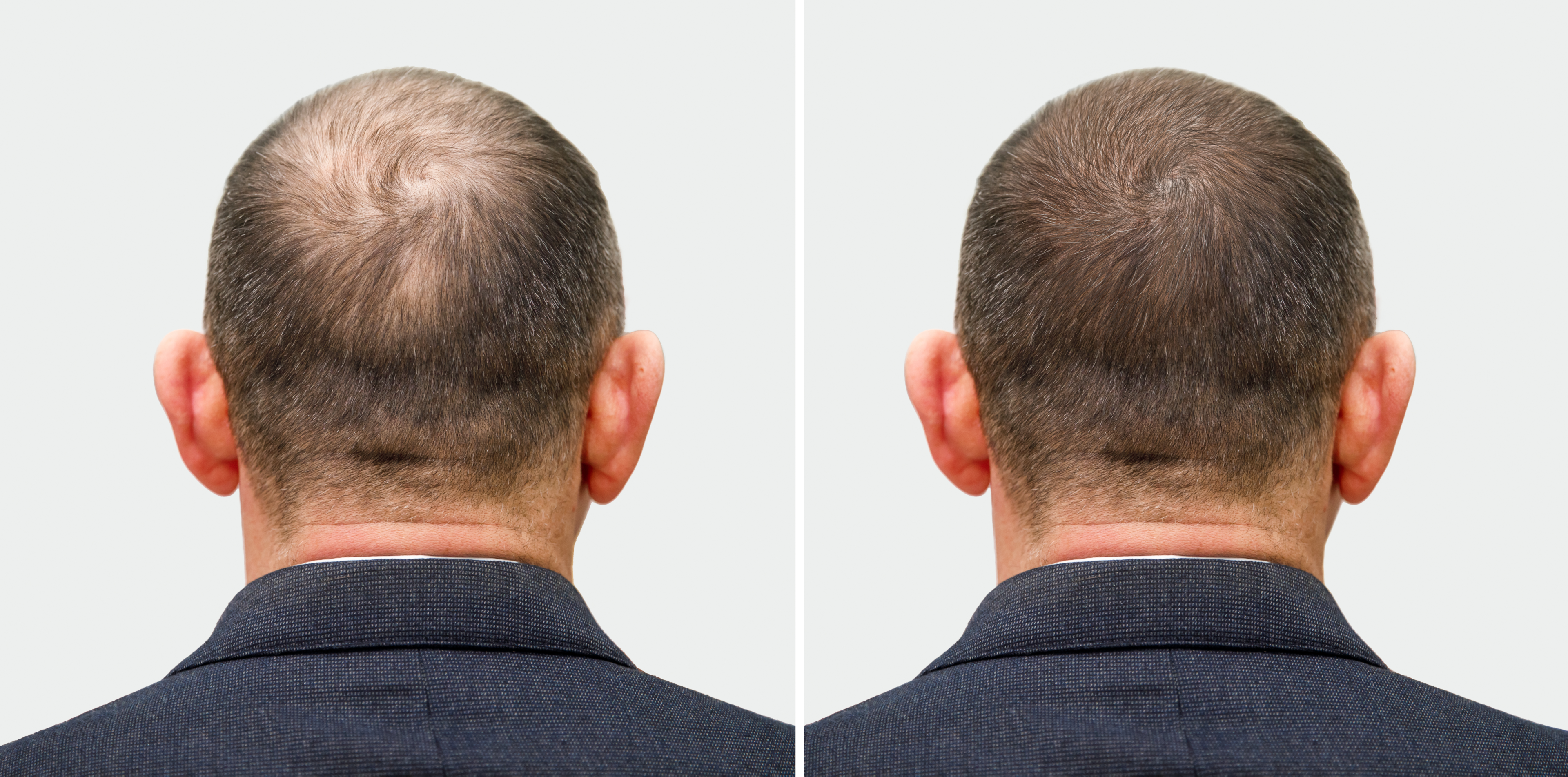 Alles wat u moet weten over de bijwerkingen van finasteride