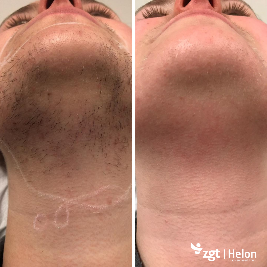 Ontdek de Voordelen van Haar Laser Behandeling voor Gezond Haar