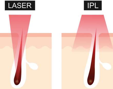 Alles over IPL-behandelingen: Effectief en Veelzijdig voor Huidverjonging en Haarverwijdering