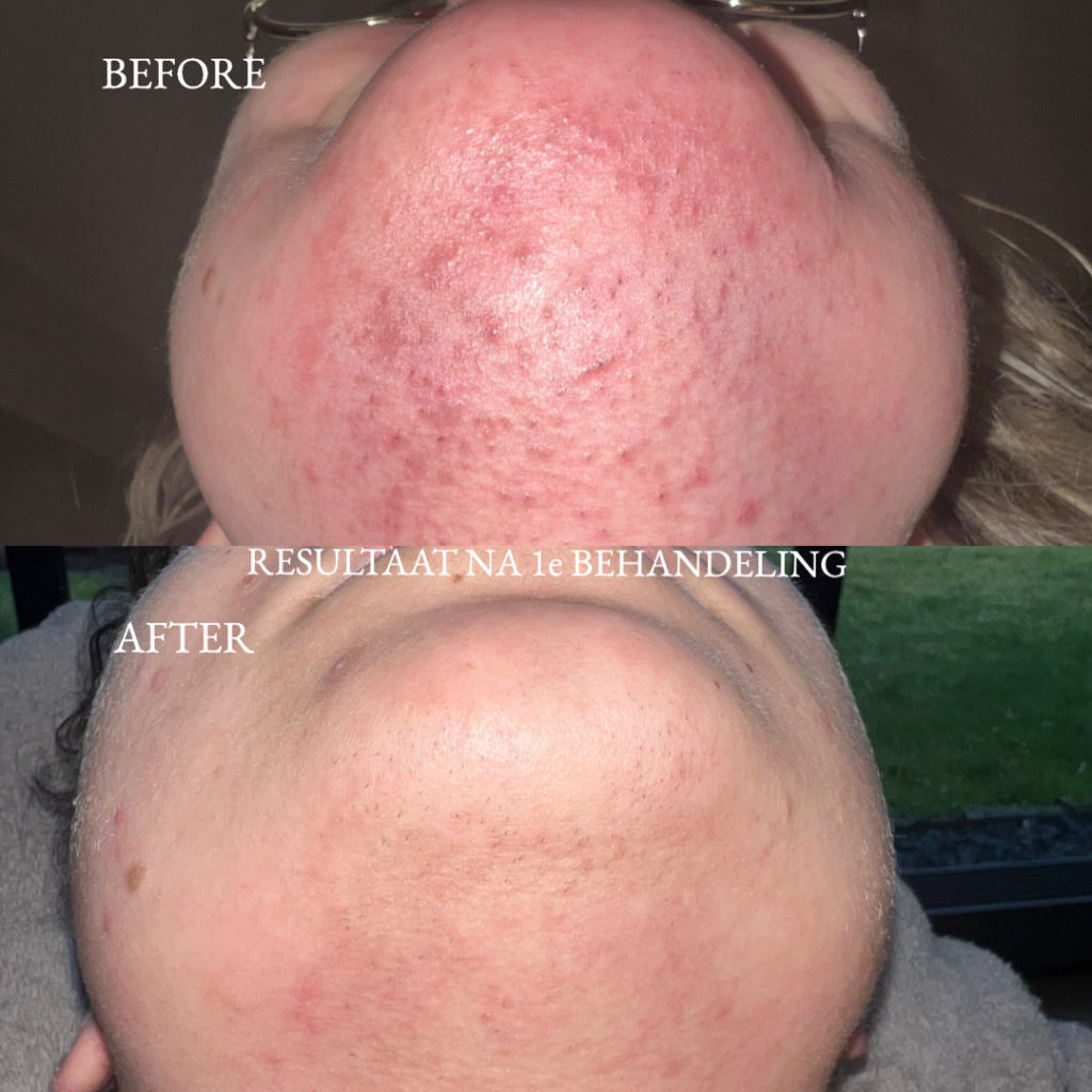 Alles over de Effectiviteit van Laser Haar Behandeling bij Haaruitval
