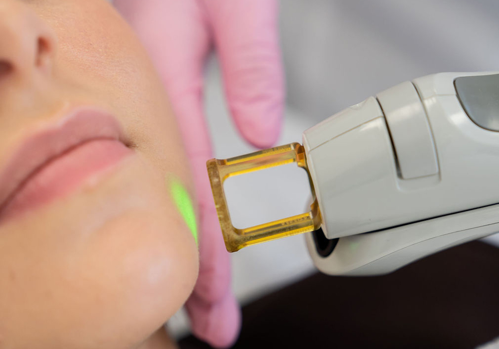 Effectieve Laserbehandeling voor Ongewenst Gezichtshaar