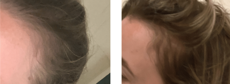 Stimuleer natuurlijke haargroei met rozemarijnolie