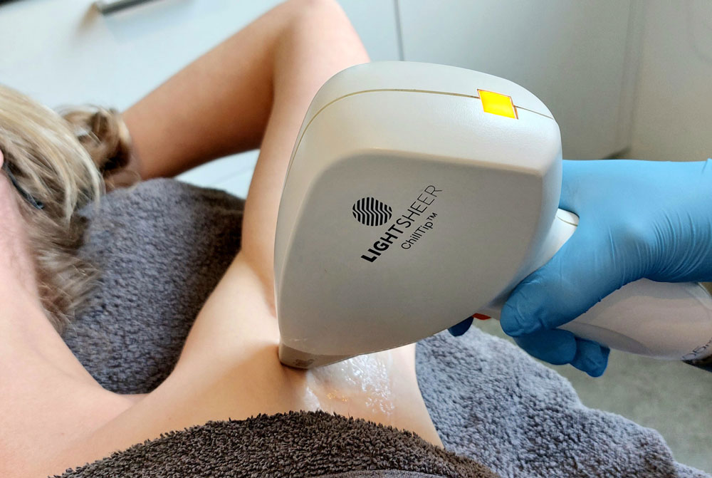 Anus ontharen met laser: alles over de behandeling, resultaten en nazorg
