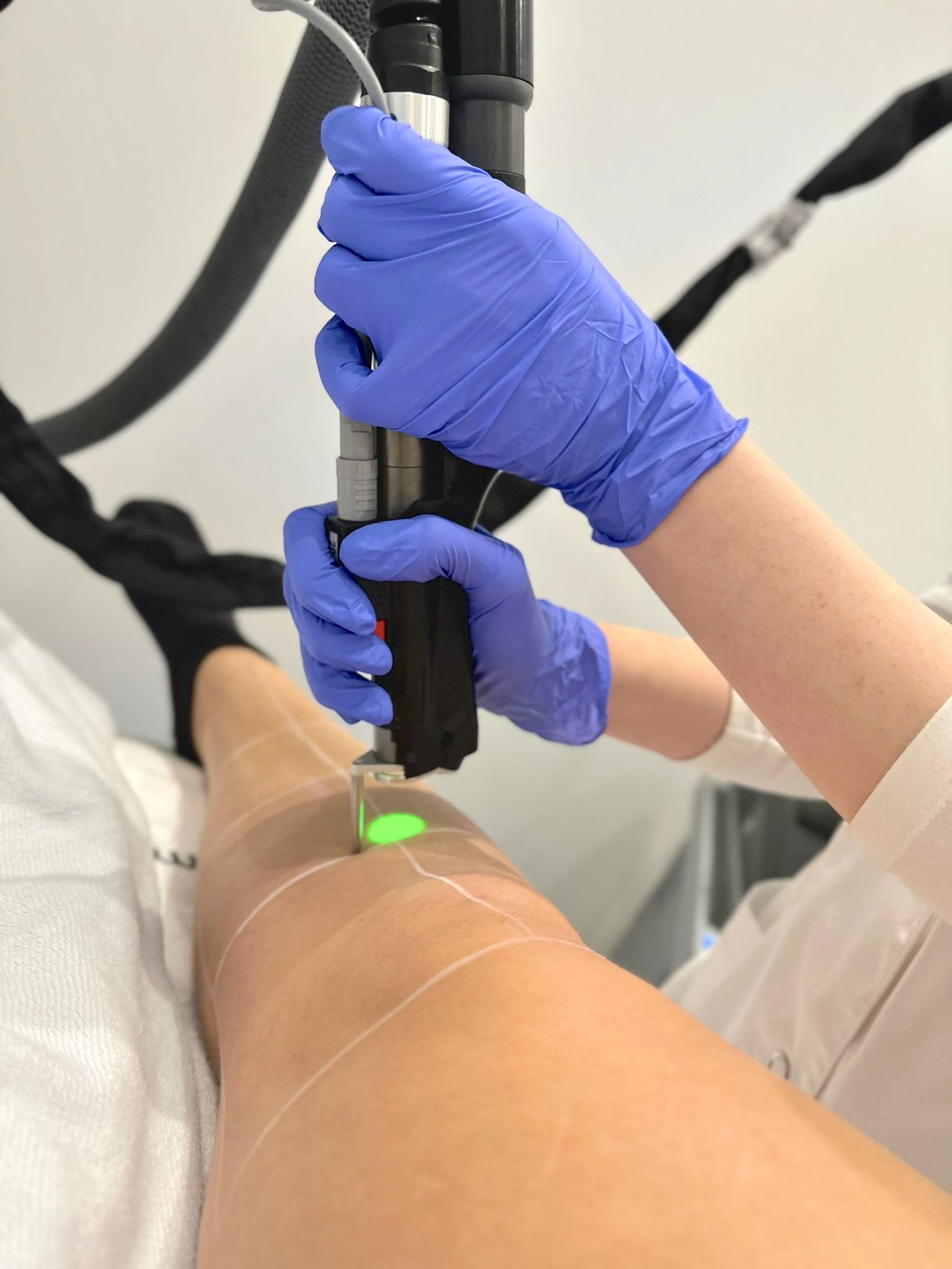 Benen ontharen met laser: alles over de behandeling