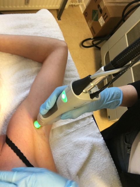Beste laser voor definitief ontharen: zo kies je de juiste behandeling