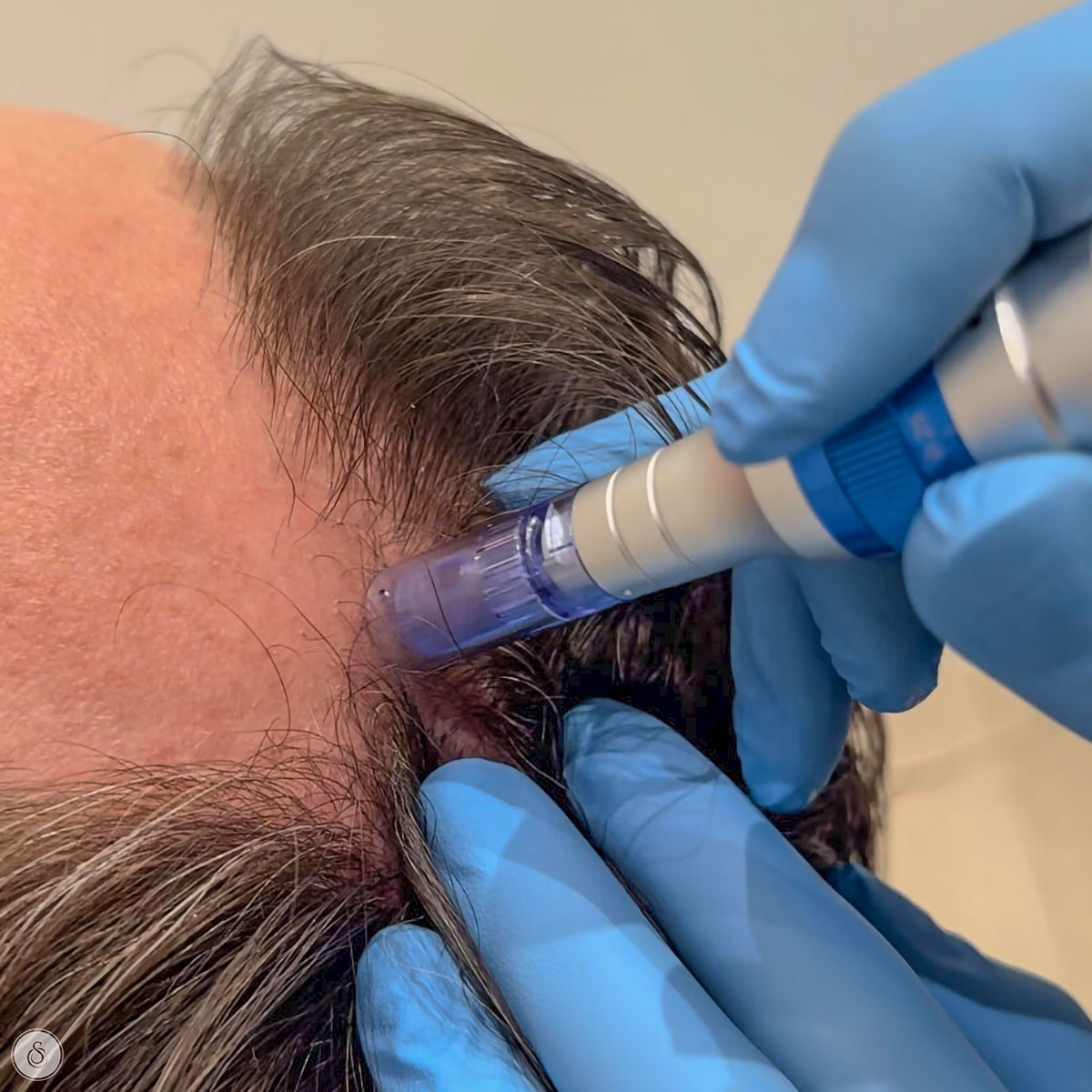 Haargroeistimulatie: behandelingen, mogelijkheden en realistische verwachtingen
