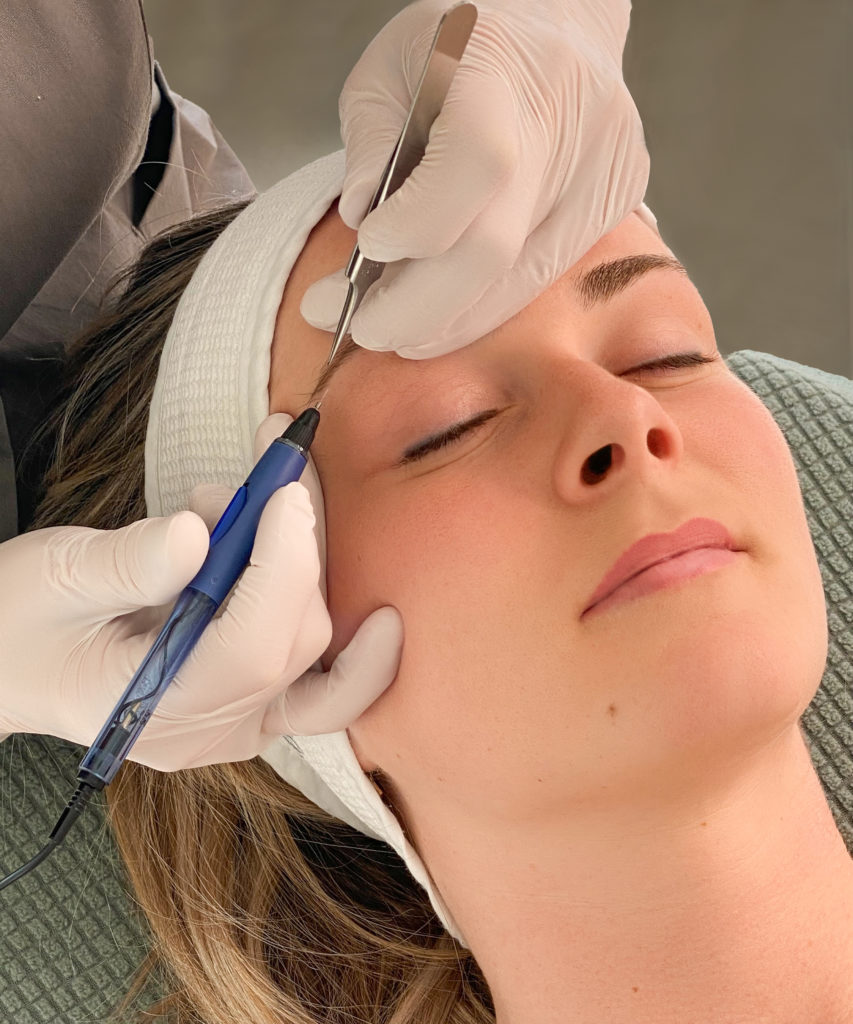 Ontharen gezicht met laser: alles over de behandeling